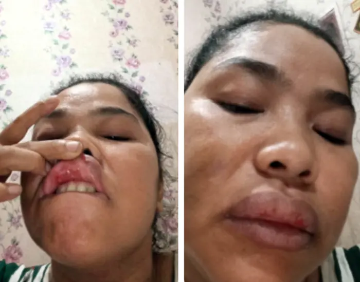 Dugaan Tabrak Lari di Jalan Lintas Sei Bejangkar, Korban Alami Luka dan Kerugian Materiil